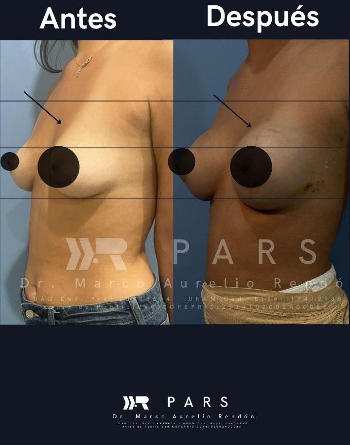Fotografía de una vista lateral de los cuidados postoperatorios aumento de busto en mujer operada