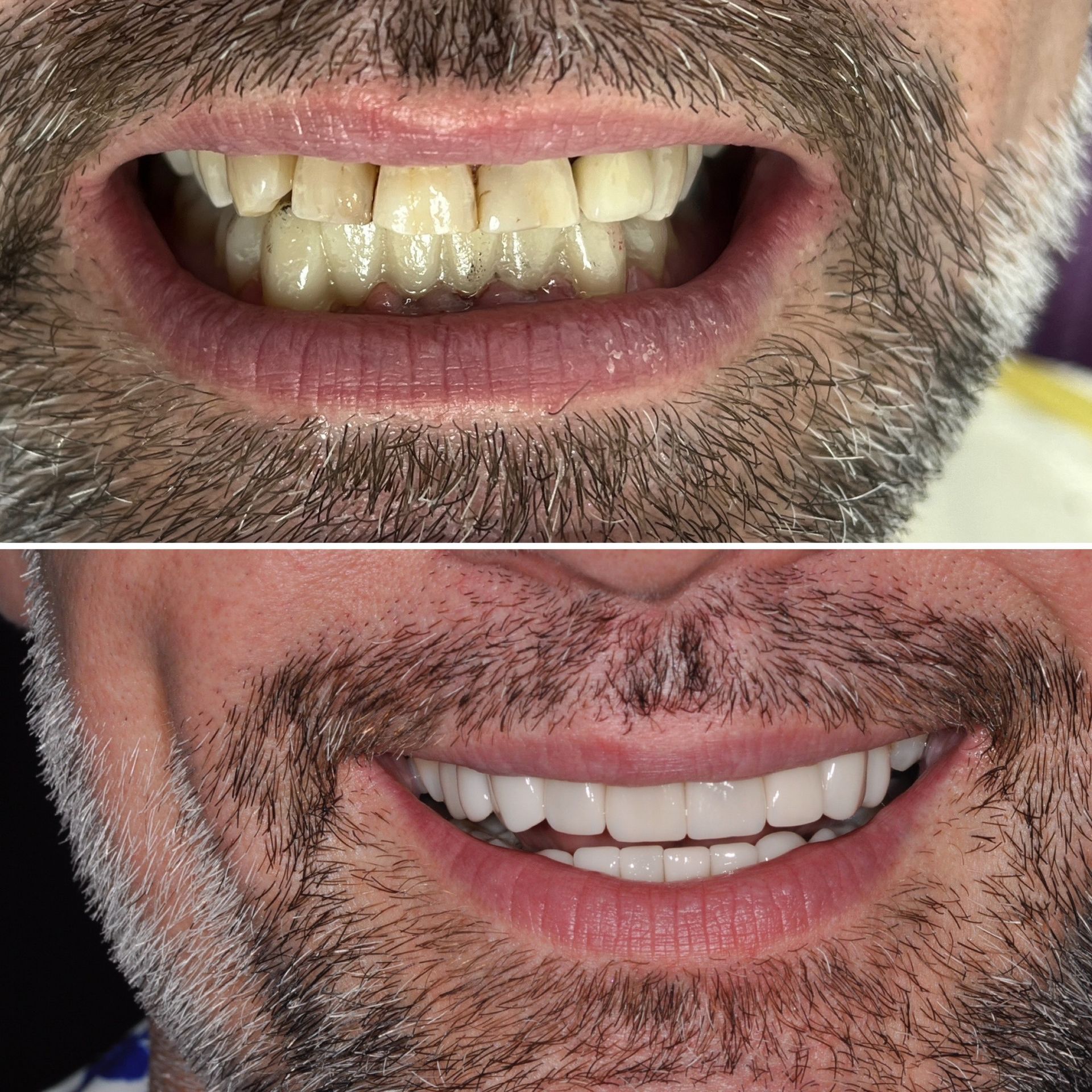 Full Mouth Veneers in Panama - Gianna The Dentist - Gianna Hanly