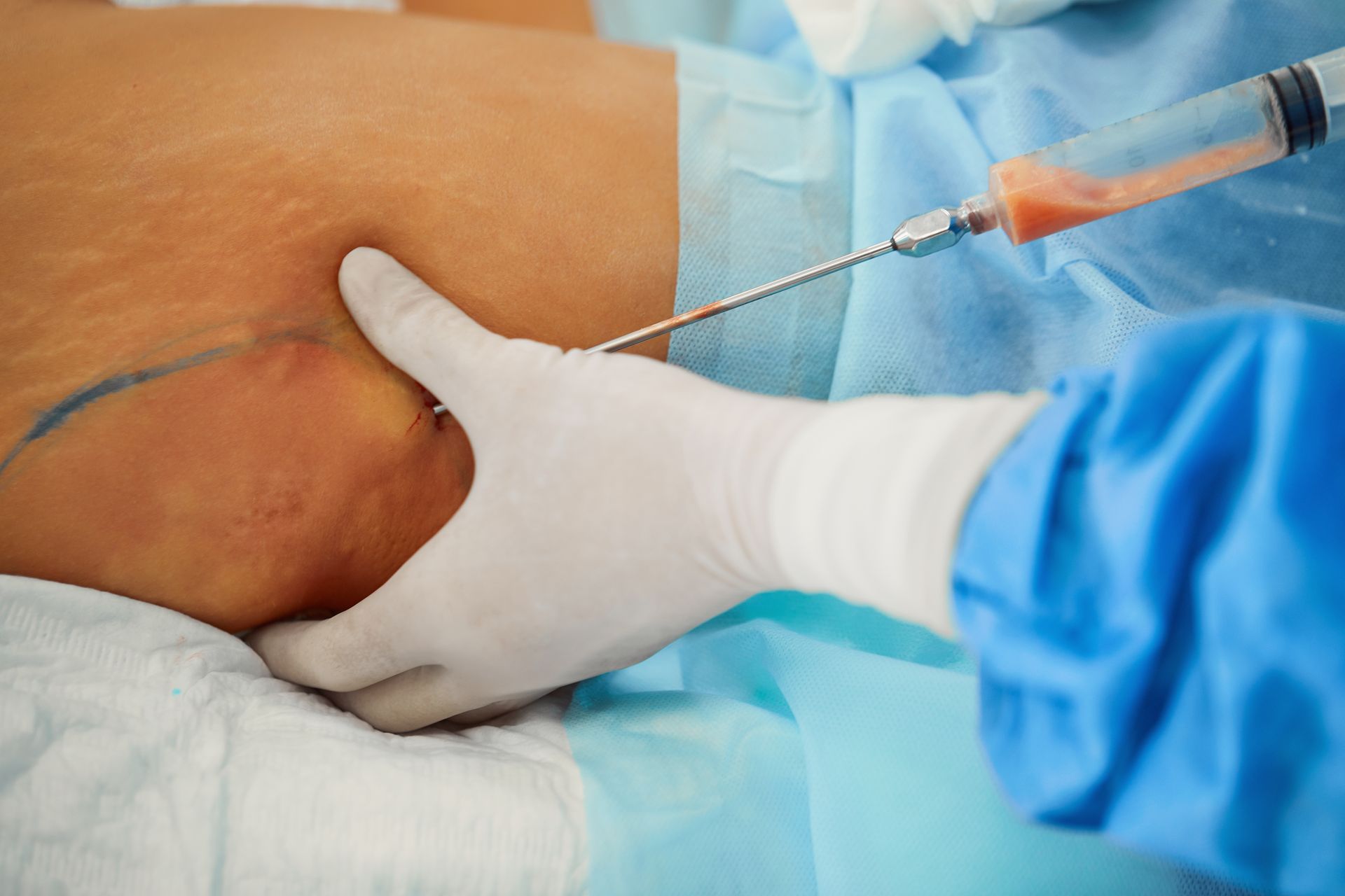 Foto de un especialista realizando uno de los tipos de lipoescultura que se ofrecen en PARS Foto de un especialista realizando uno de los tipos de lipoescultura que se ofrecen en PARS