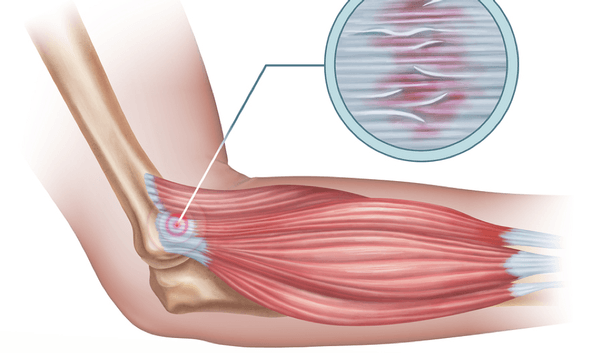 tennis elbow