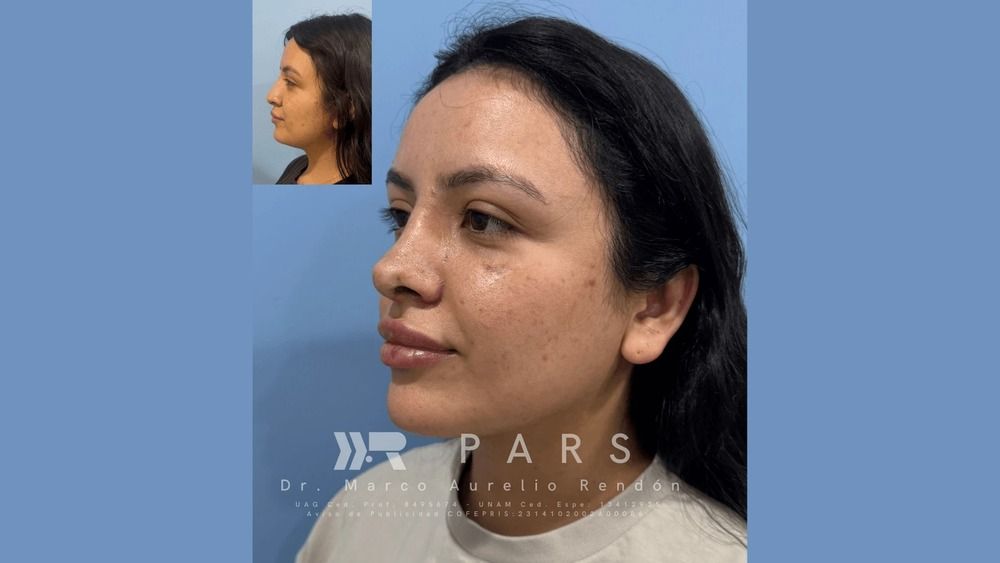  Foto de una mujer recién operada ya que sabía a qué edad se puede hacer una rinoplastia
