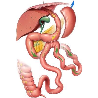 رسم يوضح عملية الساسي SASI لعلاج السمنة وتقليل الوزن