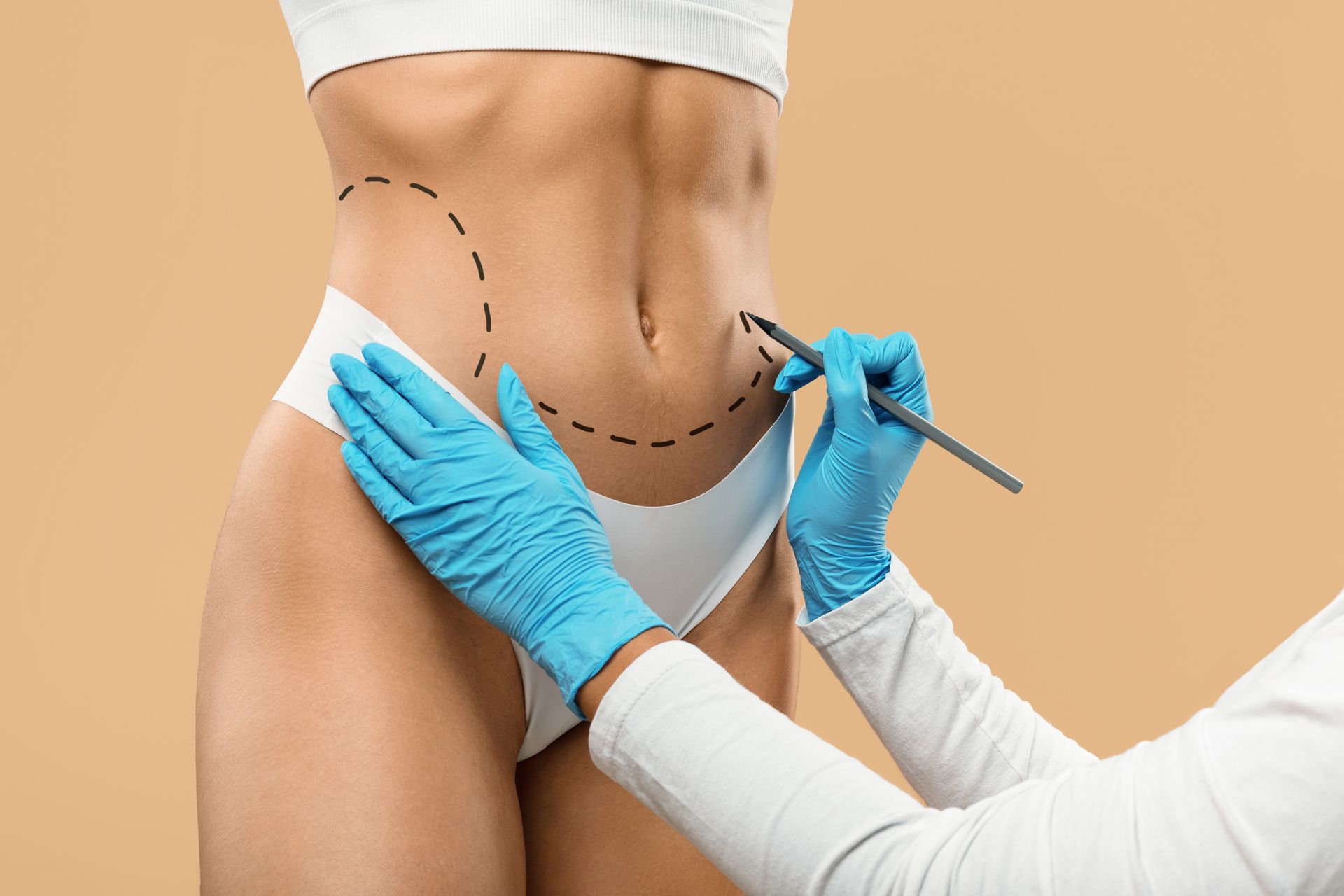 Fotografía de un médico marcando el abdomen de joven para realizar uno de los tipos de lipoescultura Fotografía de un médico marcando el abdomen de joven para realizar uno de los tipos de lipoescultura