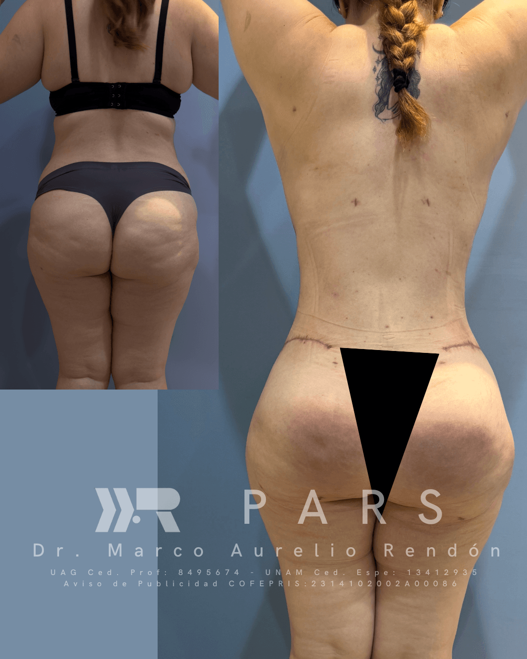 Fotografía de la espalda de mujer que está en recuperación de blefaroplastia días clave y cuidados