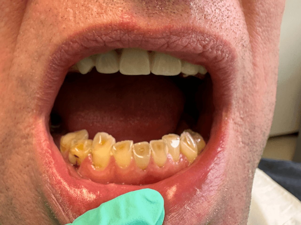 Before dental treatment