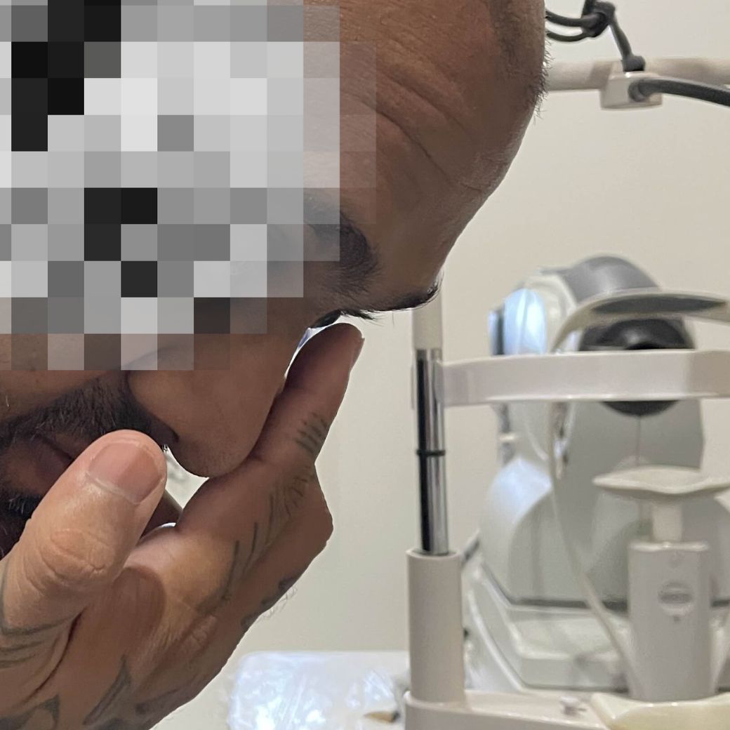 Keratoconus Thailand OPTICARE DR+