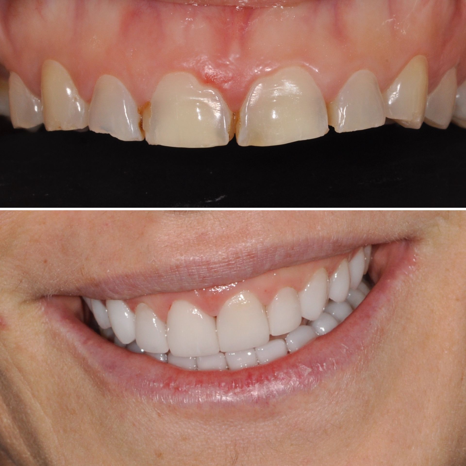 Gianna Dentist - Veneers - Full Mouth - Panama 