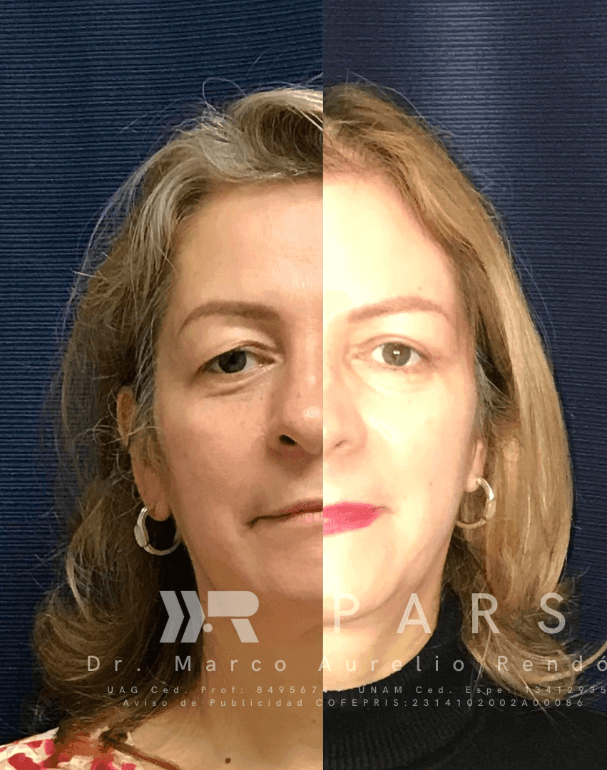 Fotografía de una mujer rubia que se realiza tratamientos para flacidez facial después de los 40