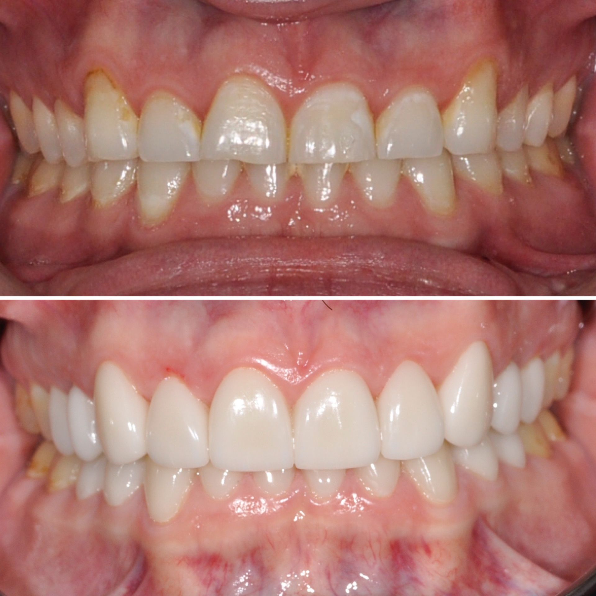 Full Mouth Veneers - Gianna Hanly - Gianna Dentist - Panama