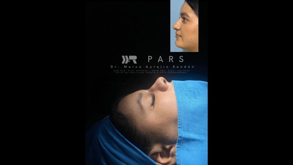 Foto en consultorio a una paciente que sabe a qué edad se puede hacer una rinoplastia siendo operada