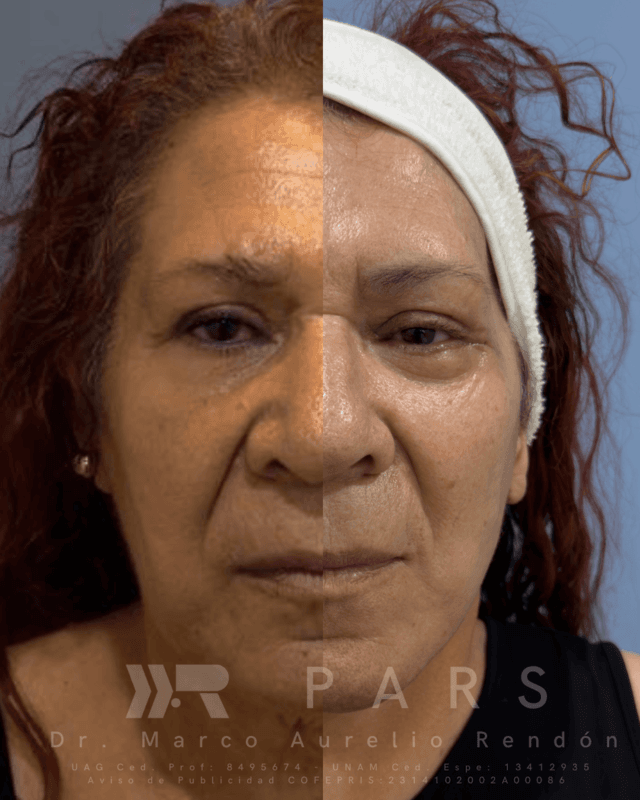 foto de la comparación de cirugía en una mujer que sabe cuanto cuesta una cirugía de rejuvenecimiento facial