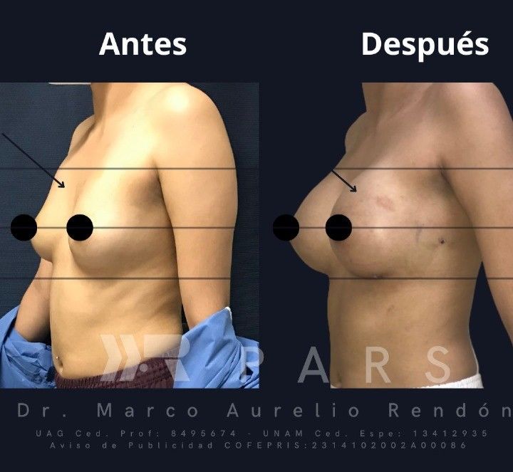 recuperación cirugía recuperación cirugía