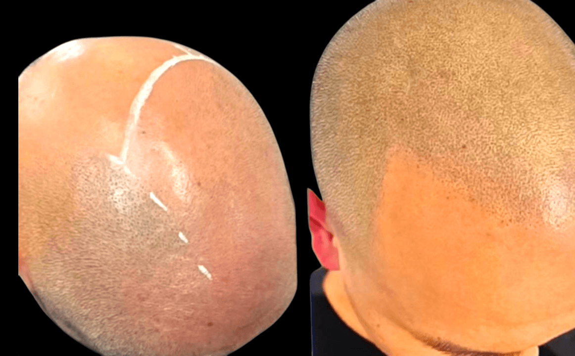 scalp micropigmentation