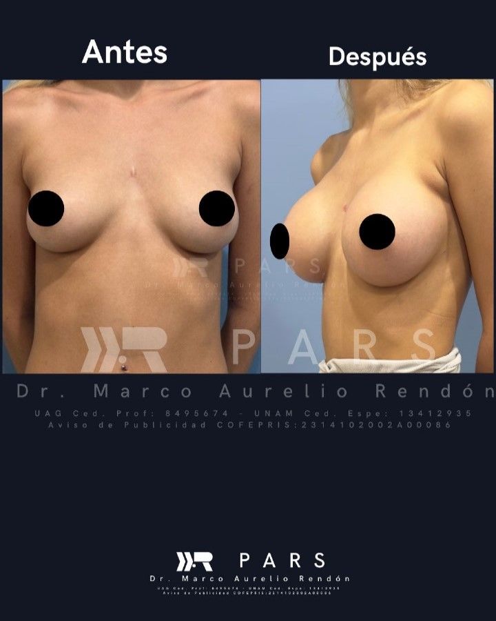 Fotografía del pecho de una mujer en representación de cuanto cuesta una operación de busto