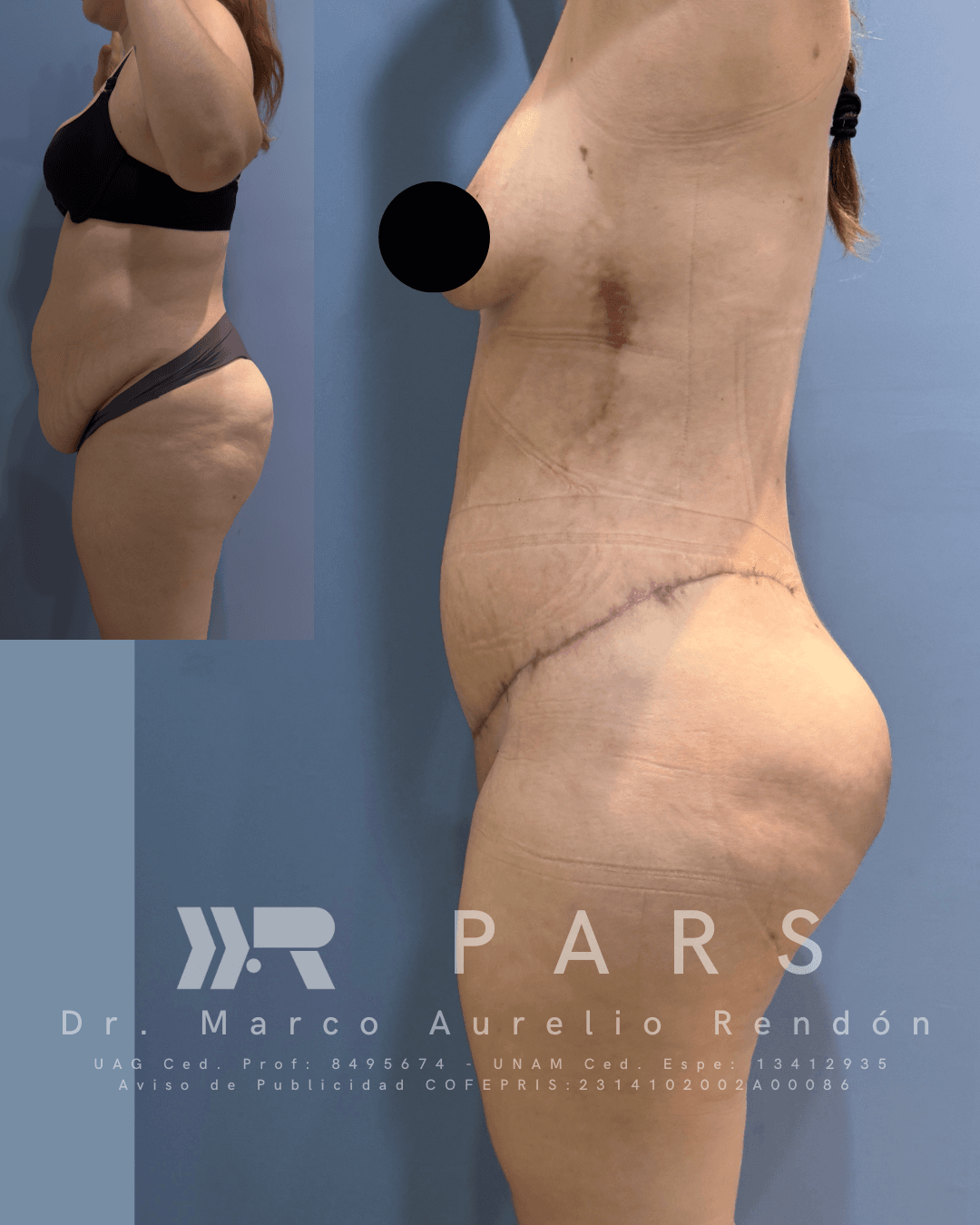 Fotografía de perfil de una joven que requiere recuperación de blefaroplastia días clave y cuidados