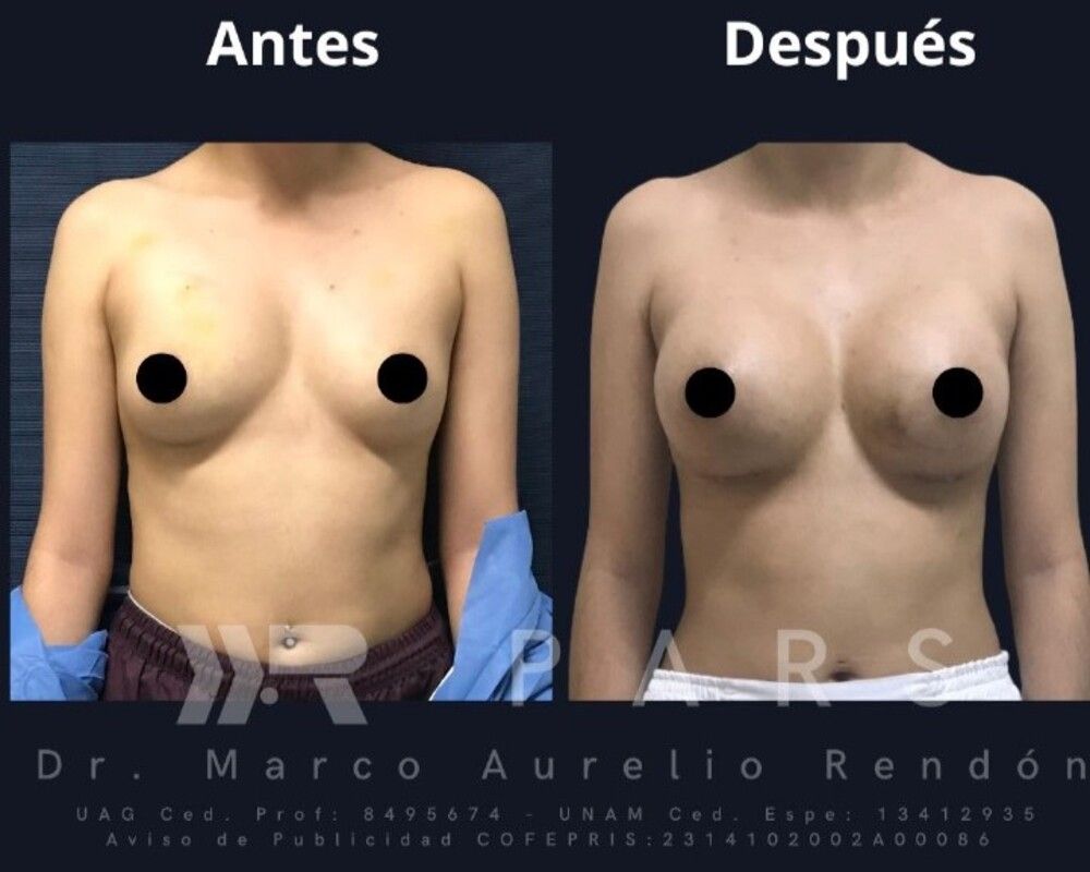 Foto de una joven que realizó su cirugía después de saber el costo de aumento de busto en PARS