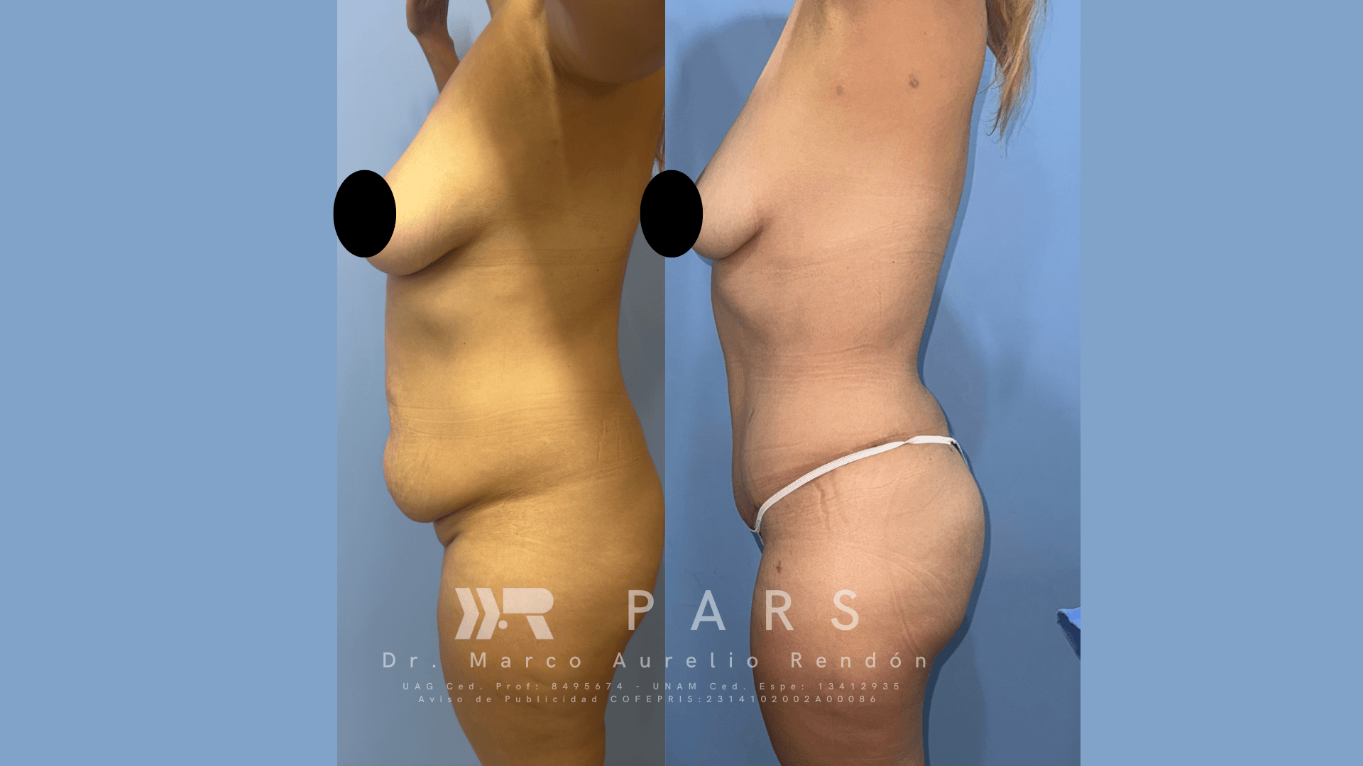 tummy tuck