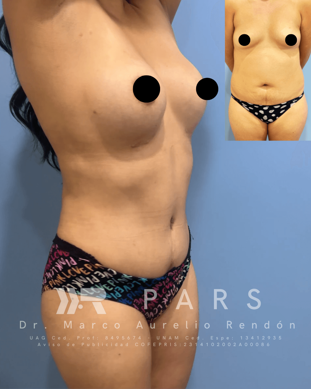 Foto de una mujer que se realizó uno de los diferentes tipos de abdominoplastia