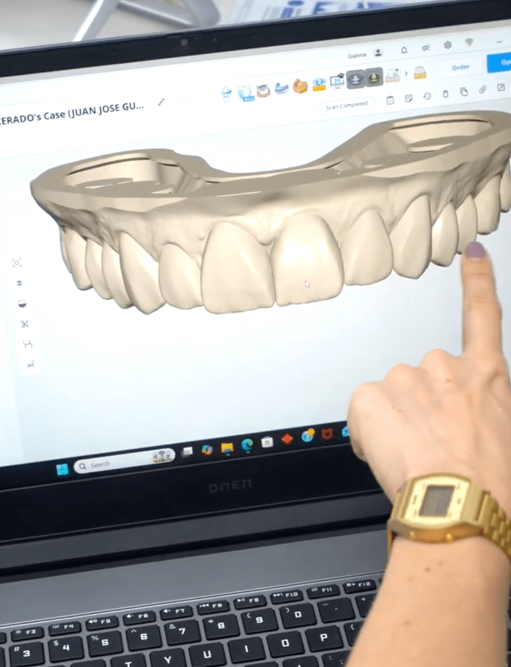 Smile Design Veneers Process Smile Design Veneers Process
