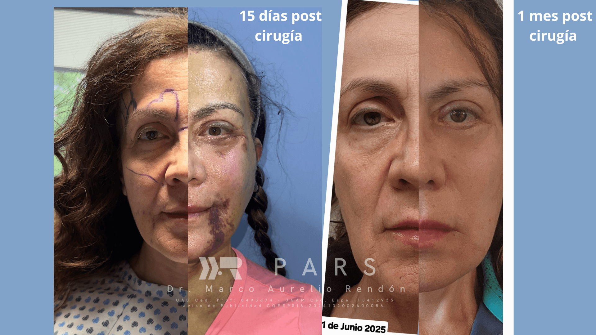 before after surgery