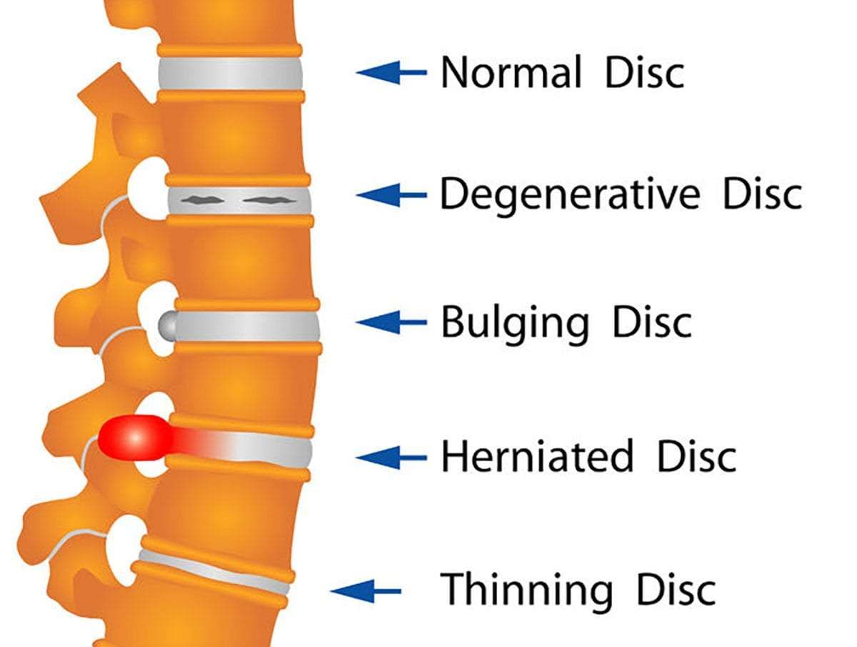 Spine Disorders Spine Disorders