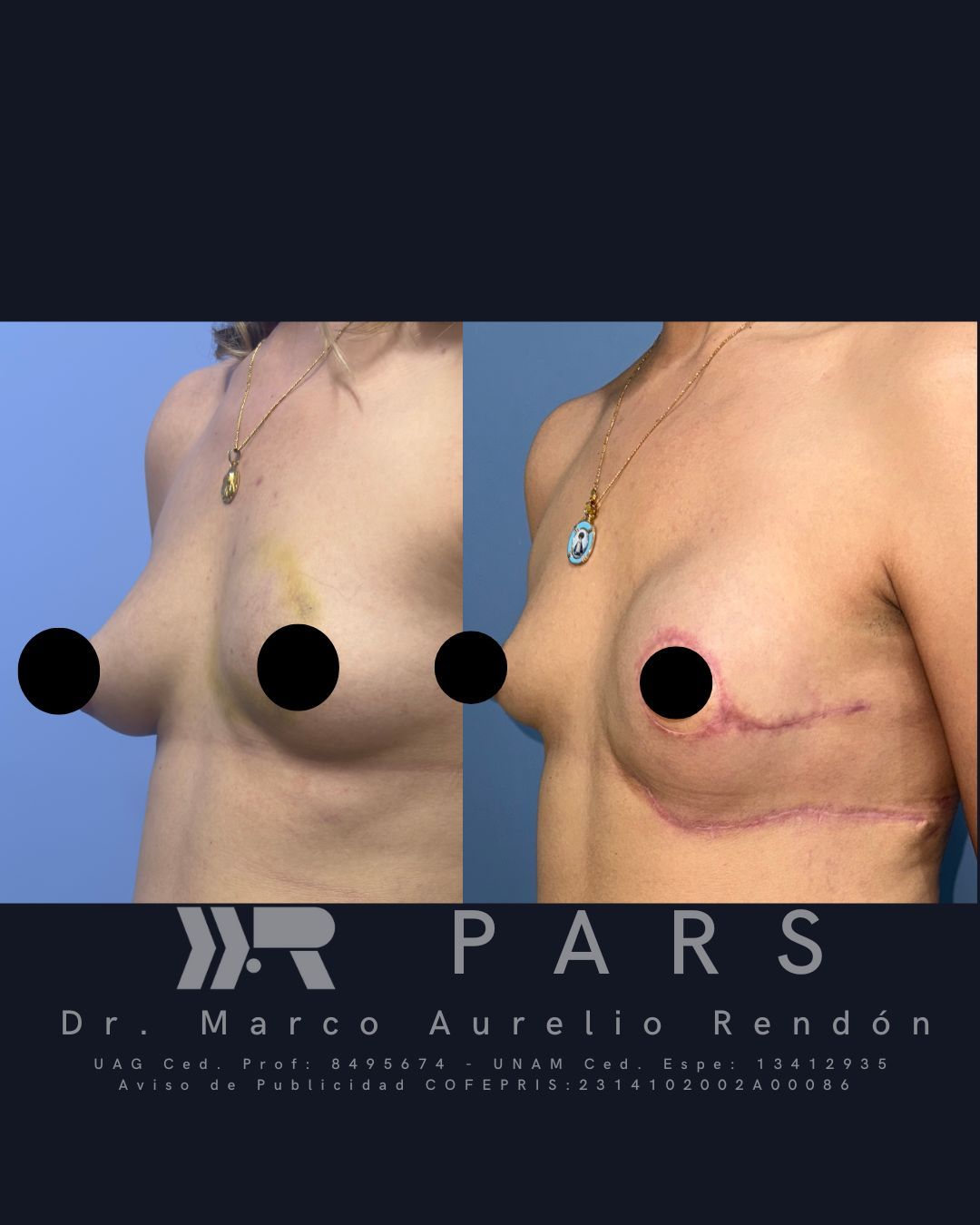 breast lift