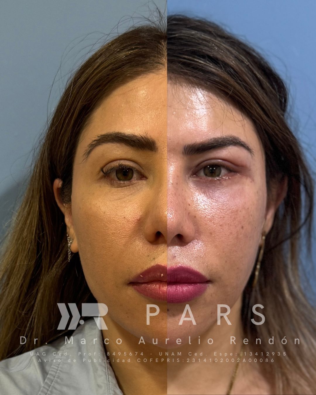 facial lift