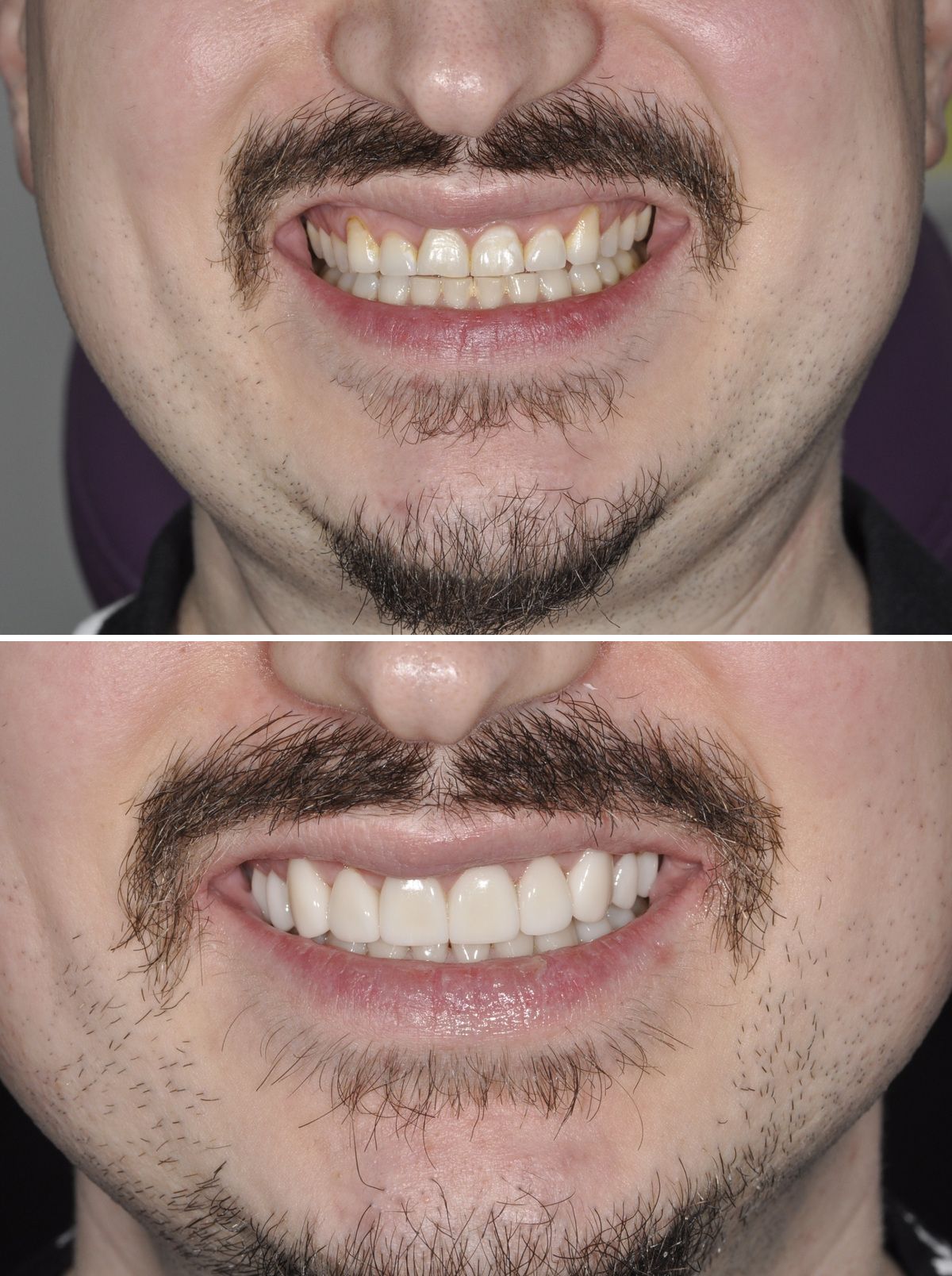 Smile Before and After - Gianna Dentist - Gianna Hanly - Panama