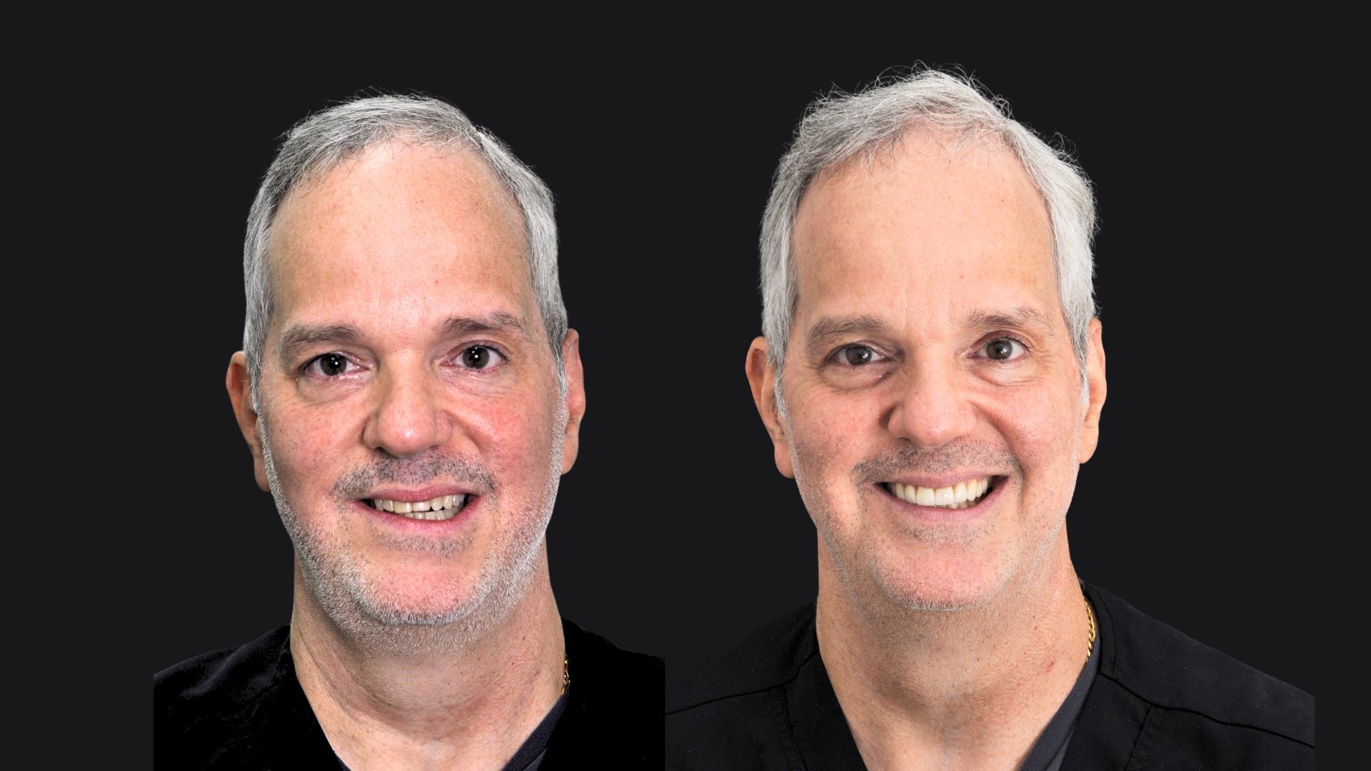 Smile Design Transformation - Gianna the Dentist - Panama Smile Design Transformation - Gianna the Dentist - Panama