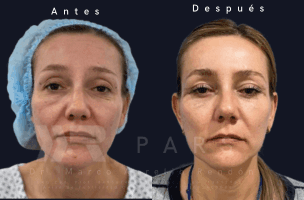  Fotografía del antes y después de una mujer que se realizó tratamientos para flacidez facial después de los 40 con PARS