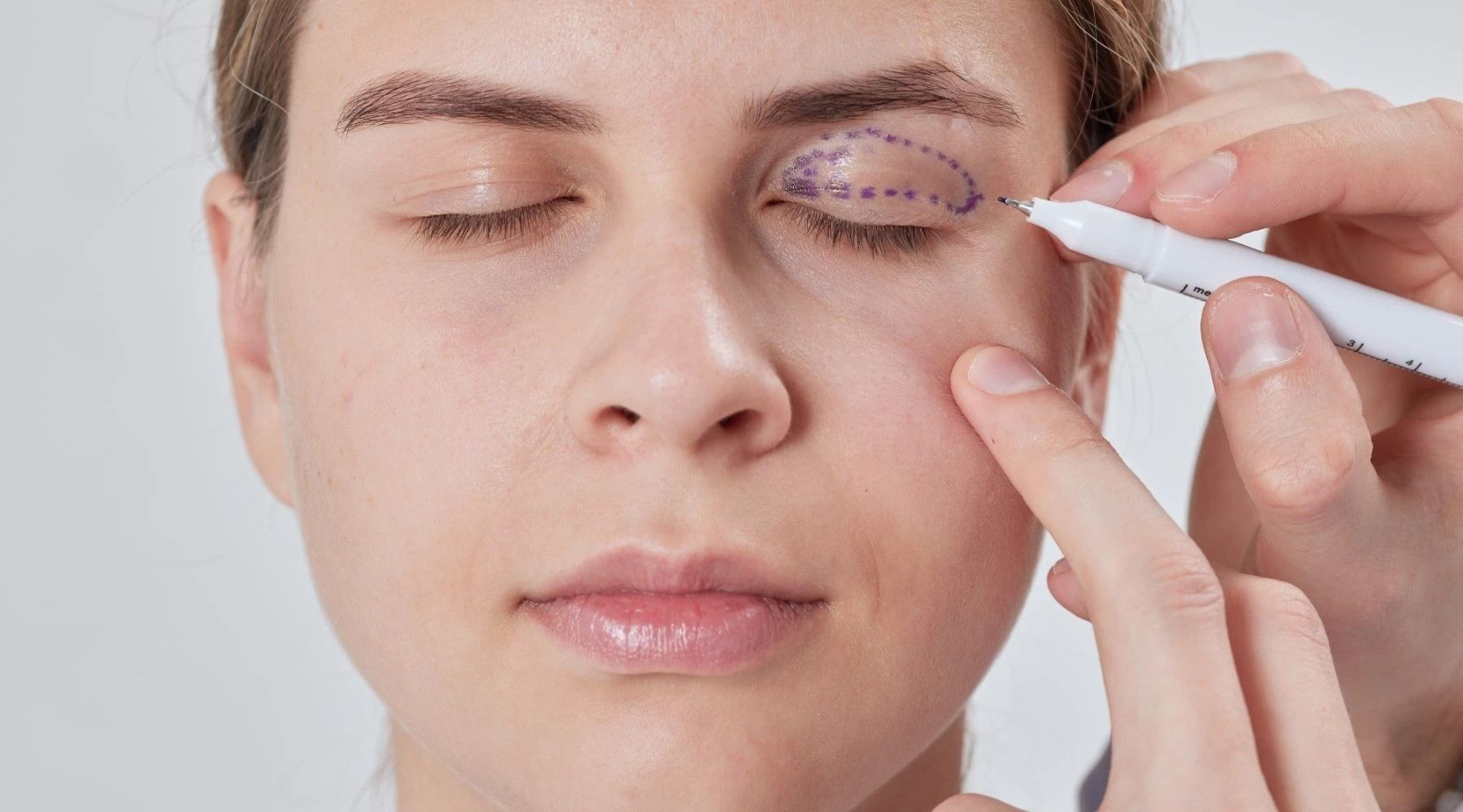  Fotografía de un paciente que sabe Cuánto cuesta una blefaroplastia en Guadalajara