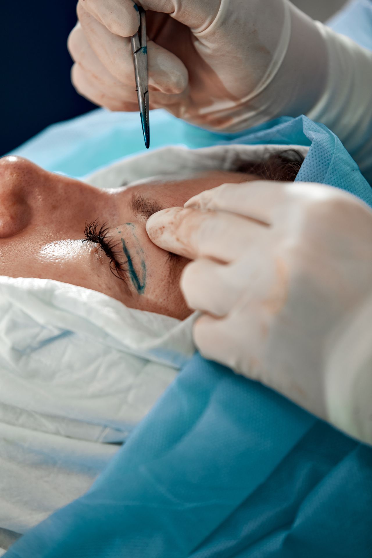 Fotografía durante el Proceso de cirugía brow lift endoscópico realizado en PARS Fotografía durante el Proceso de cirugía brow lift endoscópico realizado en PARS