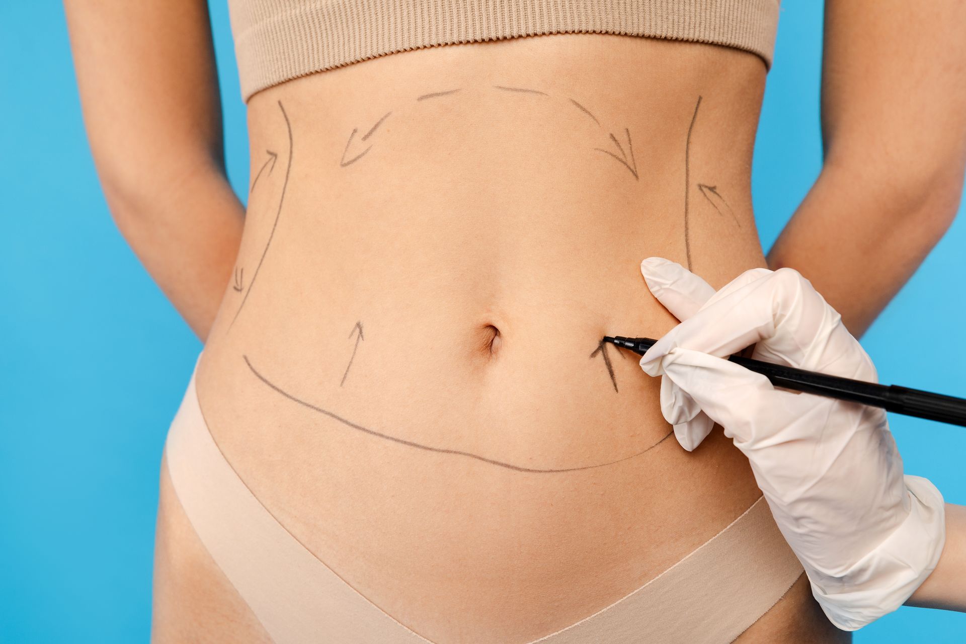 Fotografía de la mano de un cirujano dibujando en abdomen para demostrar el precio de una lipoescultura Fotografía de la mano de un cirujano dibujando en abdomen para demostrar el precio de una lipoescultura