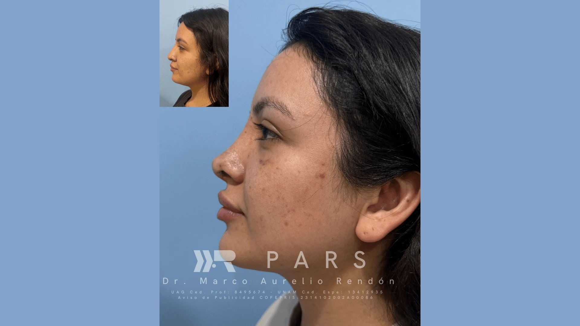 Fotografía lateral del antes y después de una joven que se operó ya que sabe cuánto cuesta una rinoplastia