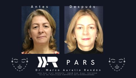 Fotografía del antes y después de una lipotransferencia a una mujer que tuvo su cirugía en PARS.