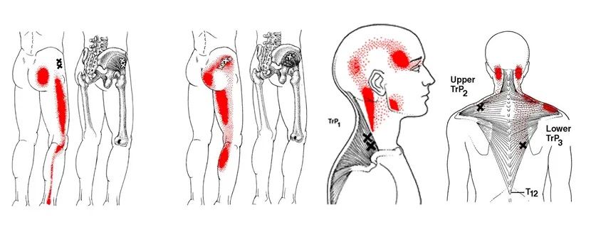 Trigger Points: A Guide to Understanding and Treating Them
