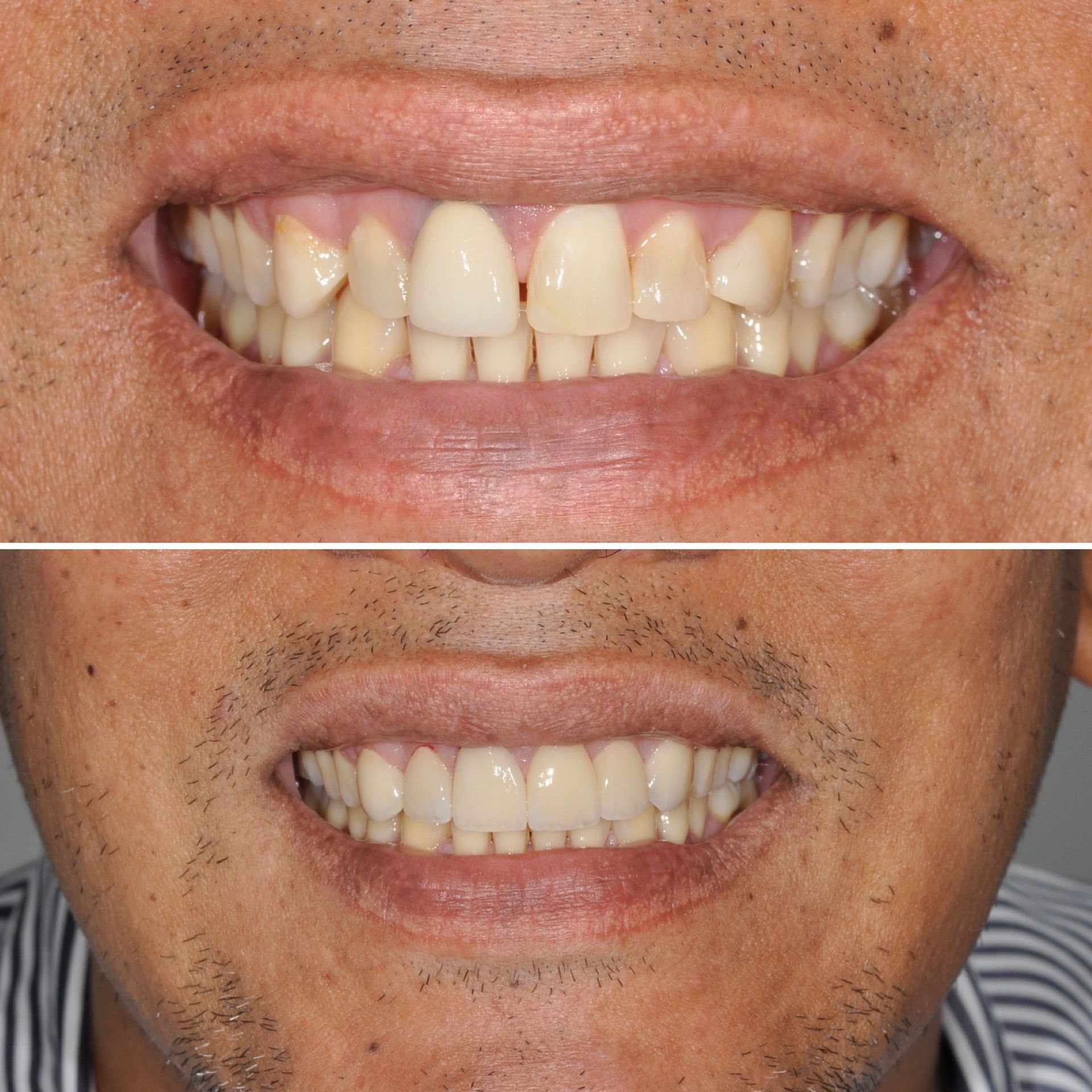 Smile Makeover in Panama: 5 Veneers & 1 Ceramic Crown - Gianna Dentist - Gianna Hanly
