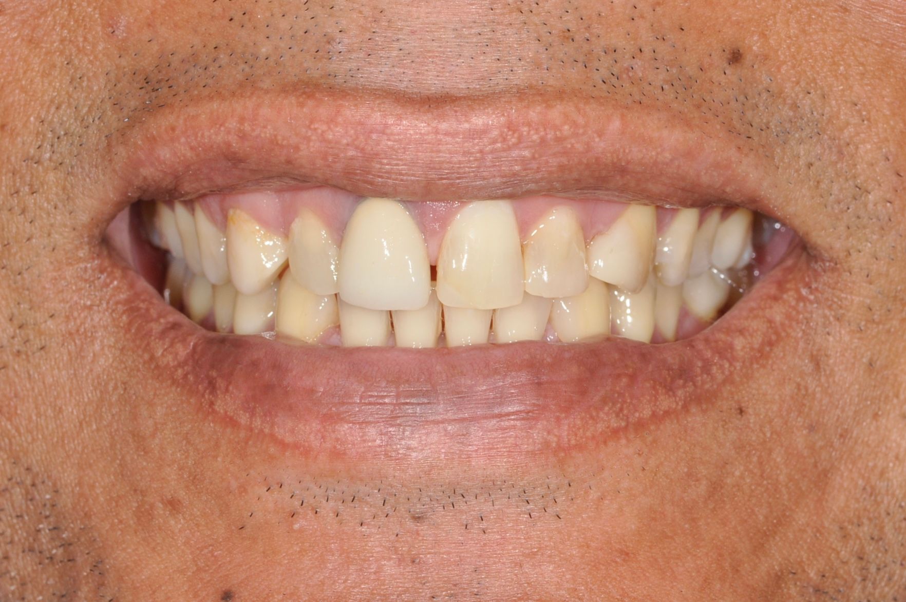 smile makeover Panama - Gianna Hanly - Dentist Panama