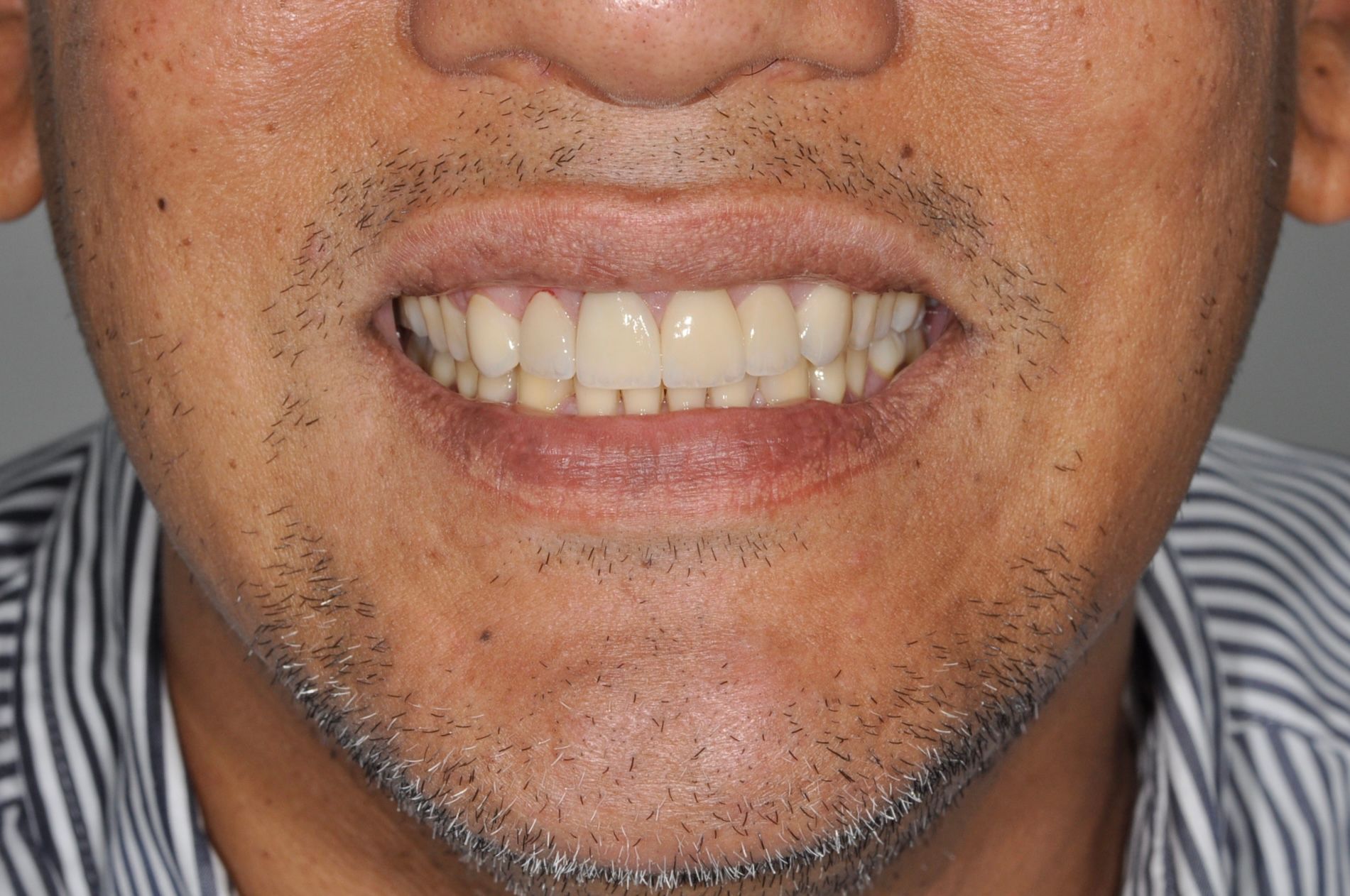 Smile Transformations / Patient Cases - Gianna Hanly 