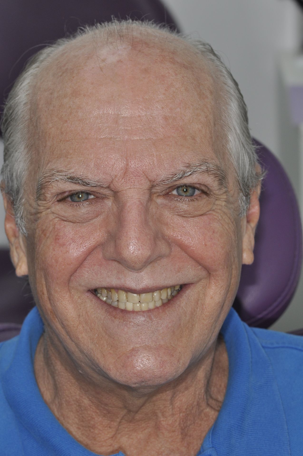 Prepped Teeth - Original Smile - Gianna Dentist