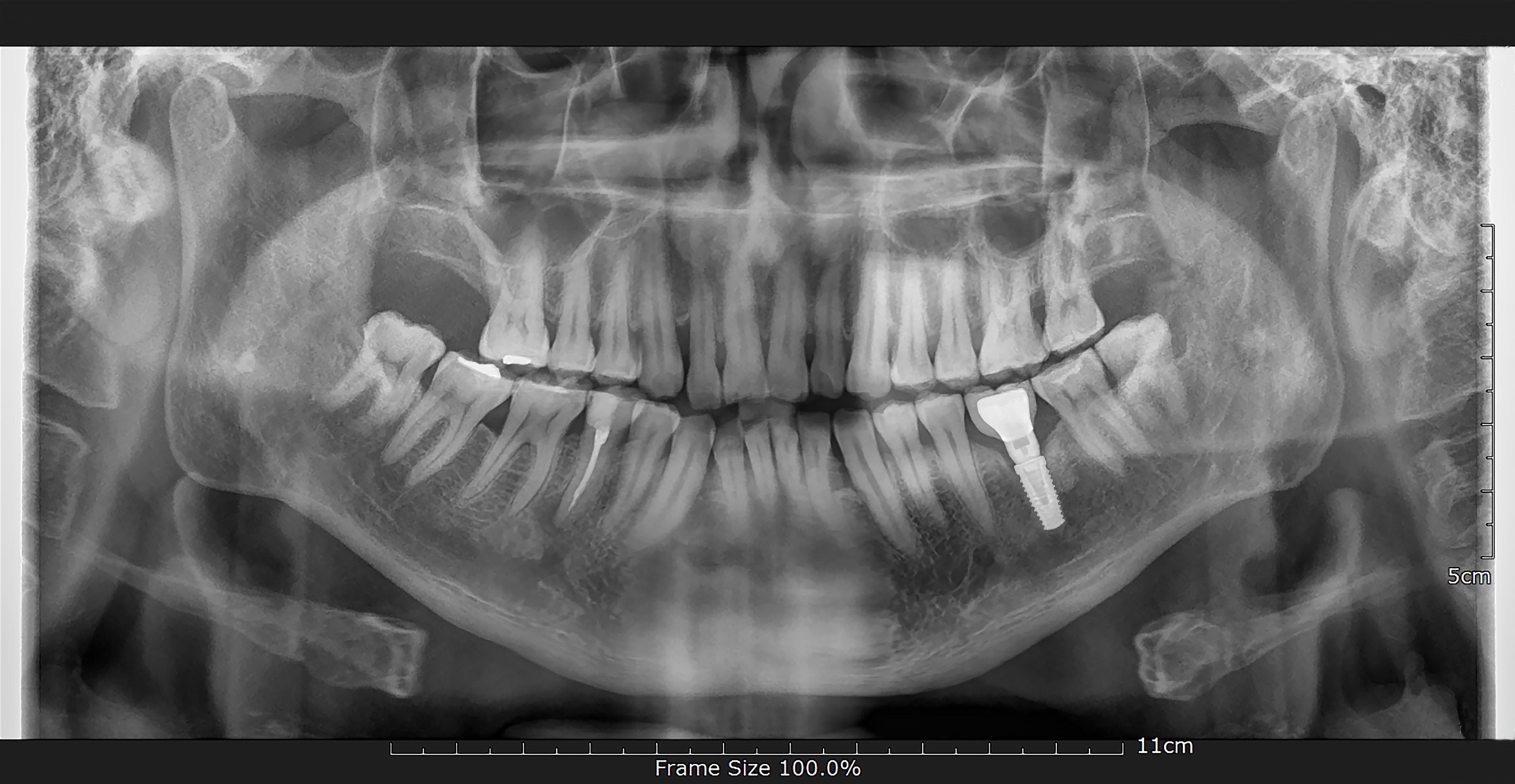 dental implants x-ray