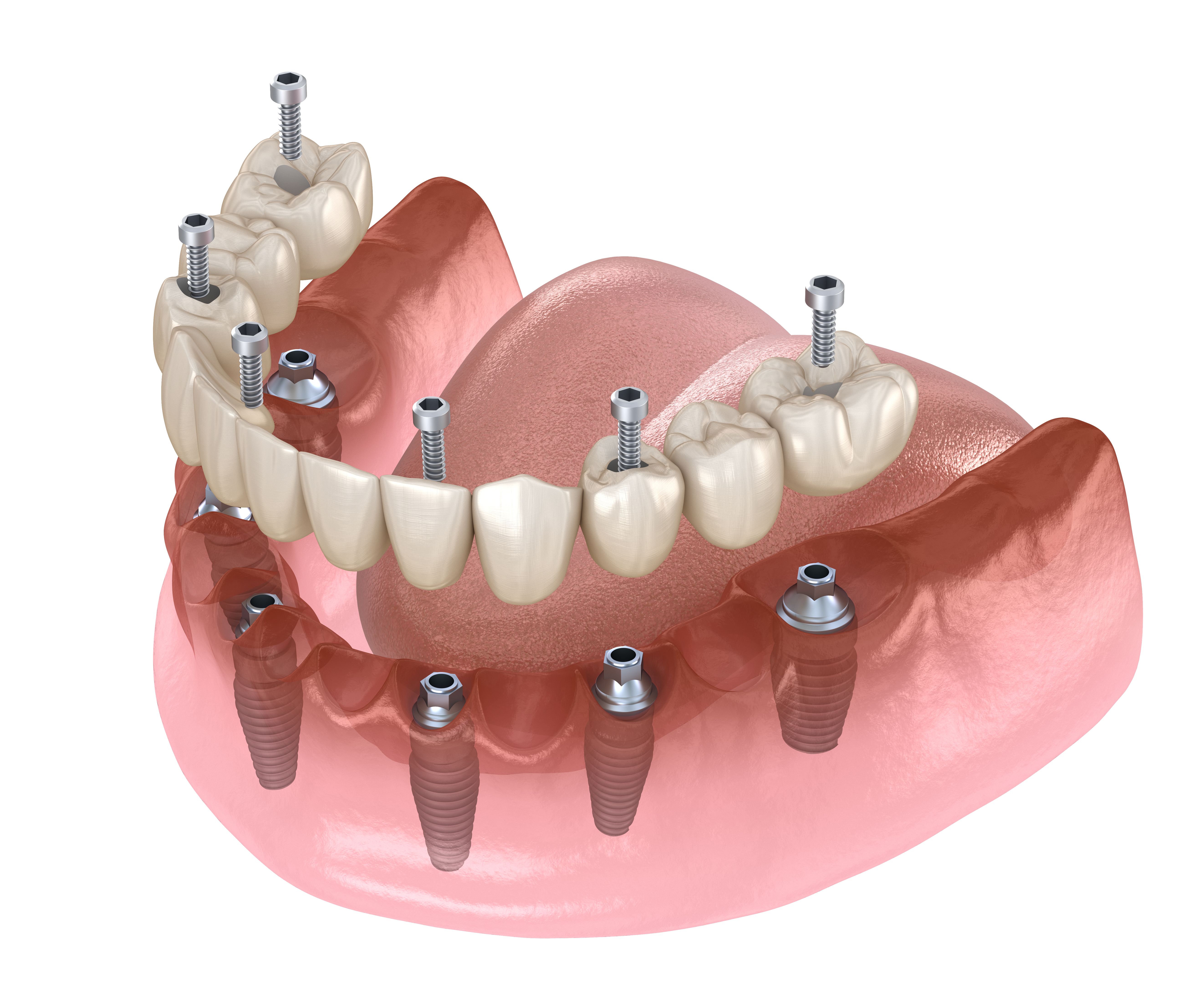Mandibular prosthesis All on 4 system supported by implants, screw fixation. Medically accurate 3D illustration of dental concept