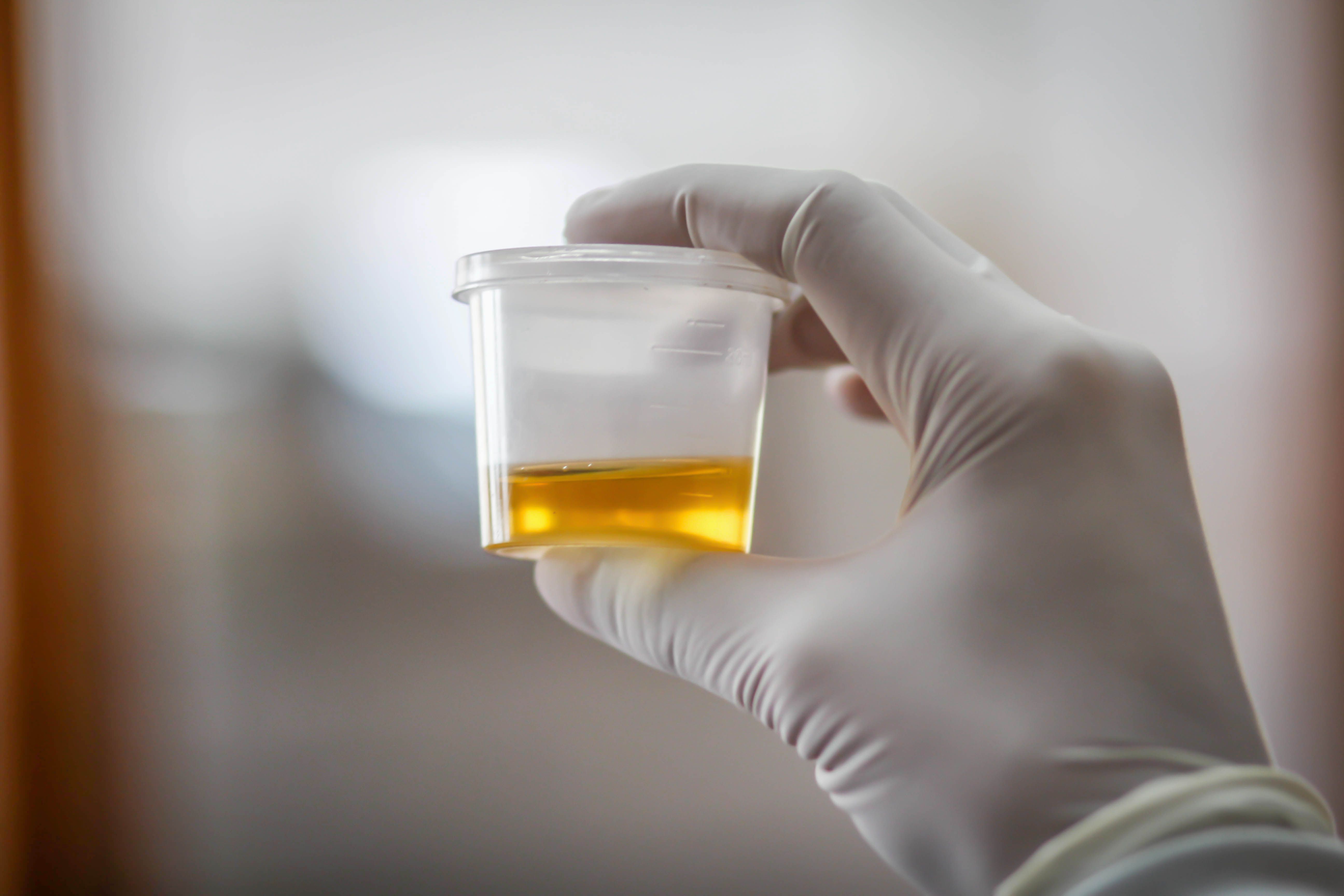 urine sample collection