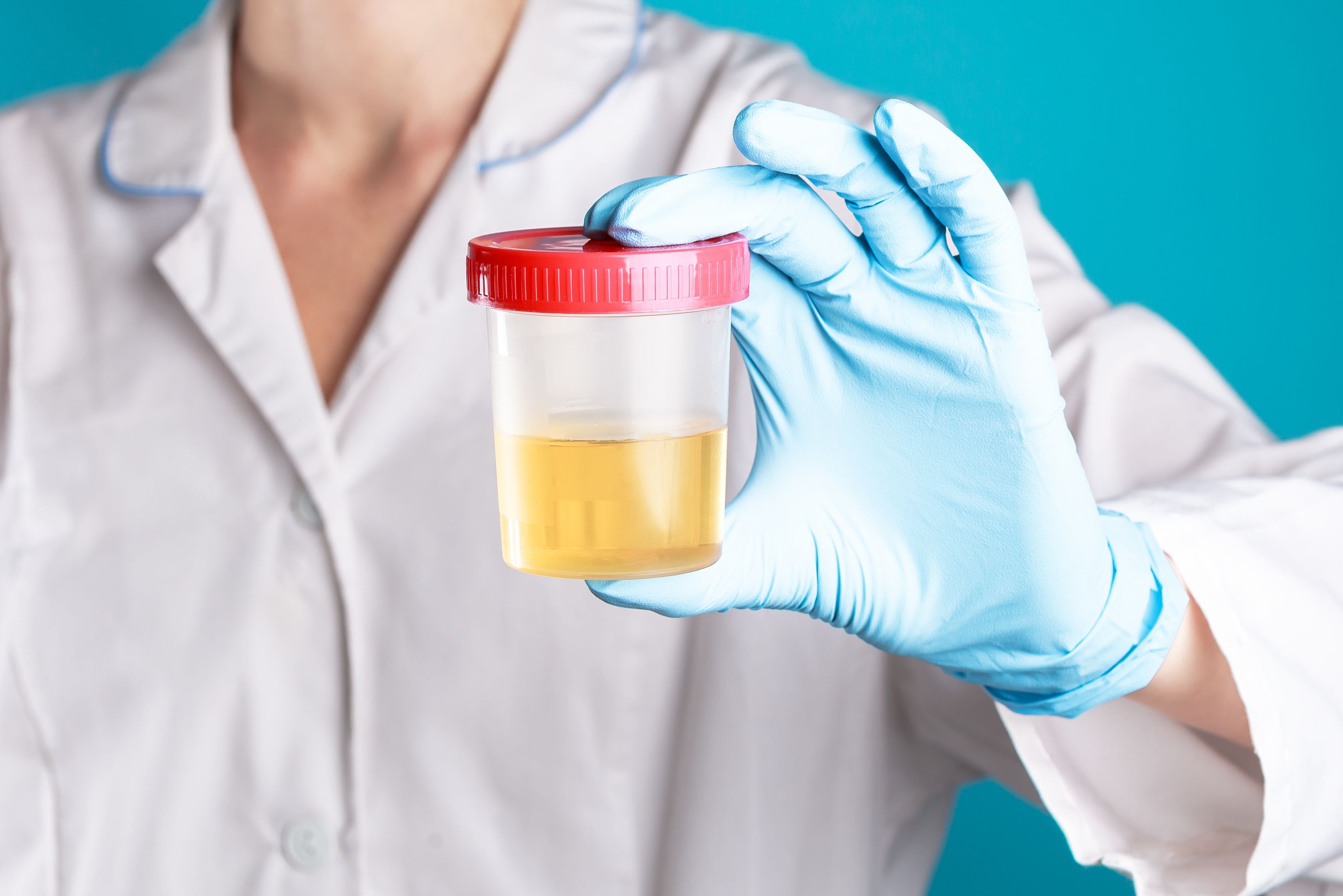 doctor in a white uniform and blue gloves on blue background holds plastic test jar with yellow urine. test for disease