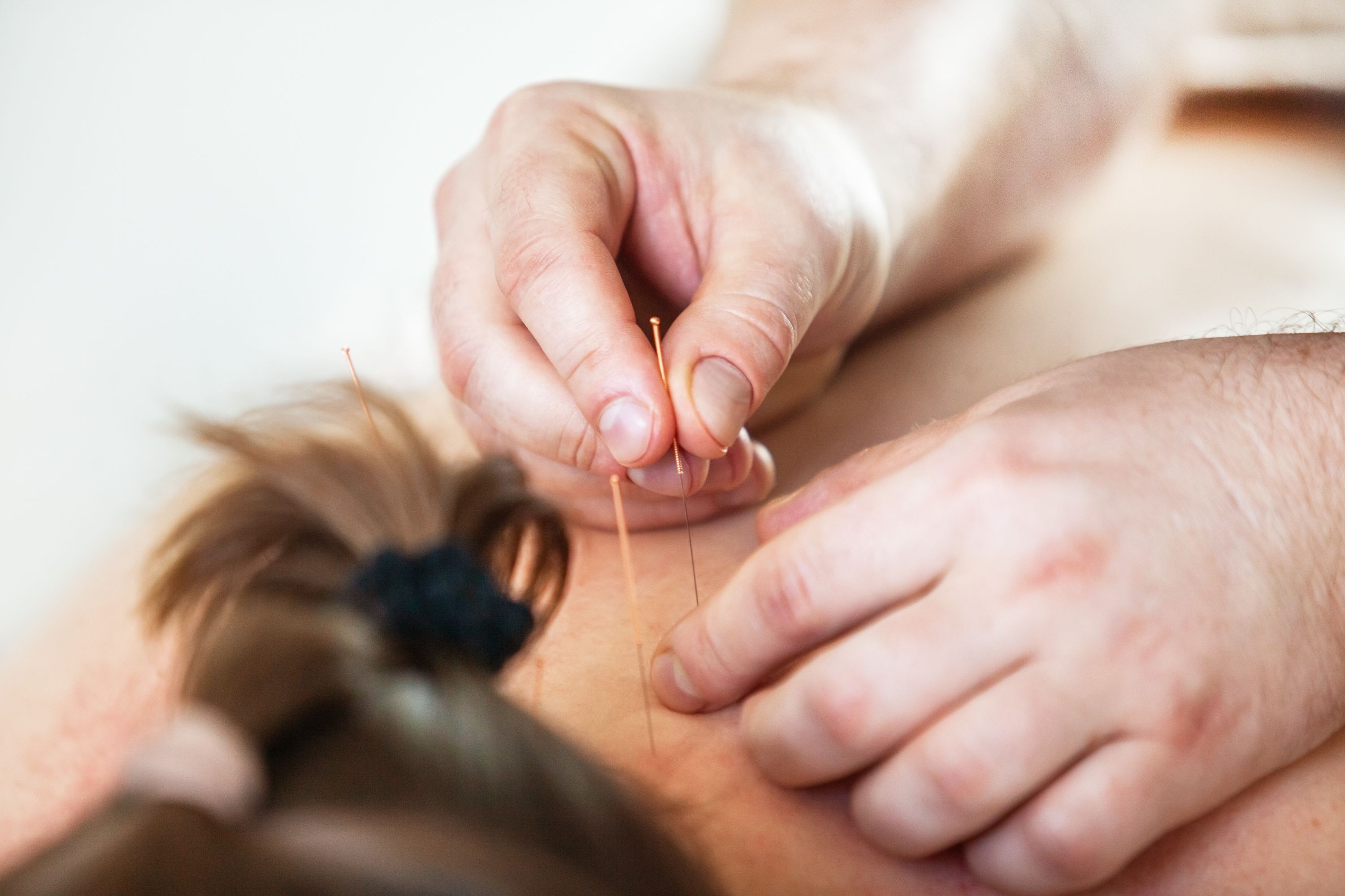 acupuncture needles