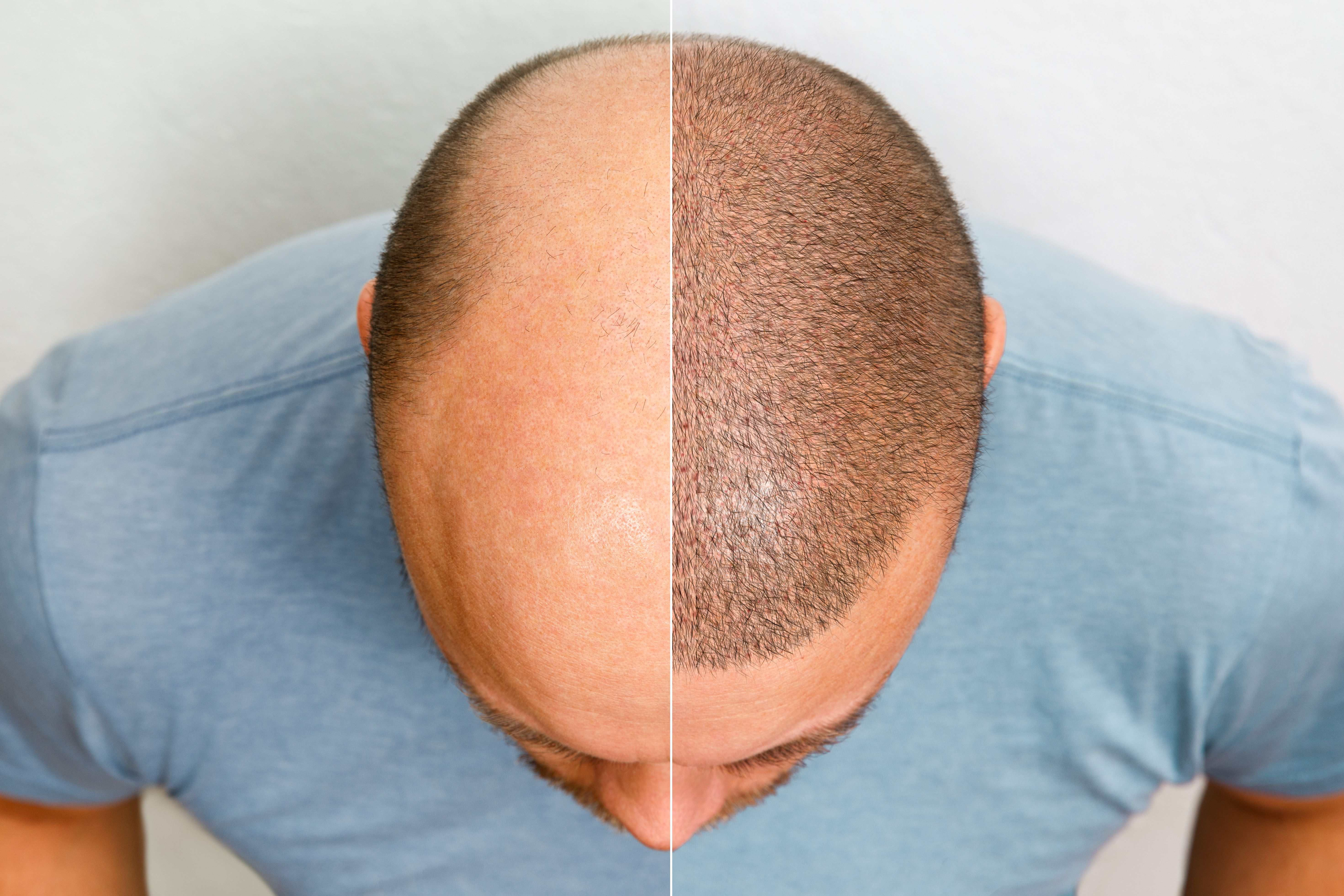 hair transplant prp leicester hair loss hair transplant prp leicester hair loss