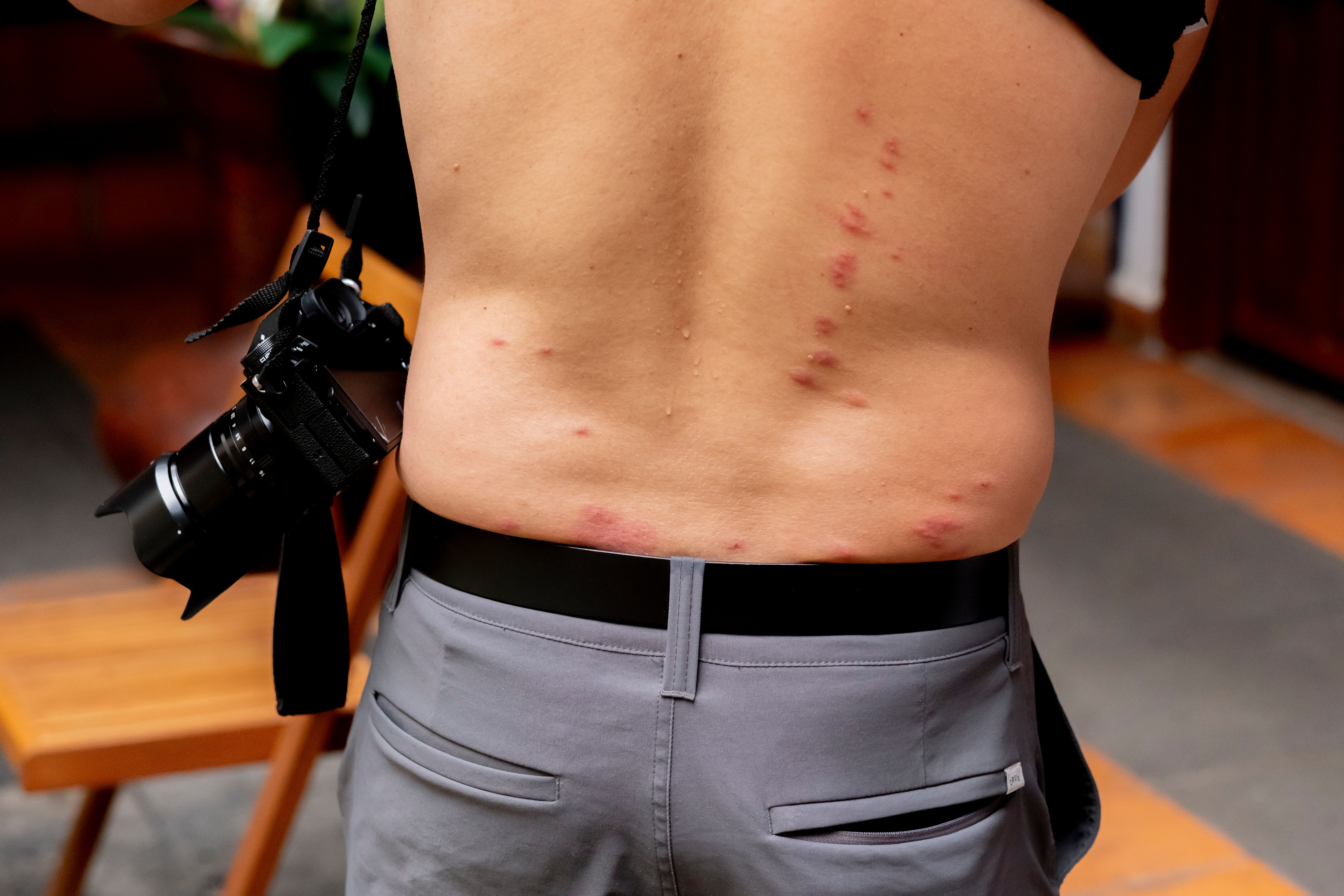 Bare back of man with camera over shoulder. Red welts on man's back caused by bedbug bites, which usually appear in irregular or straight lines and disappear on their own after one or two weeks, although it is recommended to use compresses to relieve the stress caused by the itching. Bare back of man with camera over shoulder. Red welts on man's back caused by bedbug bites, which usually appear in irregular or straight lines and disappear on their own after one or two weeks, although it is recommended to use compresses to relieve the stress caused by the itching.