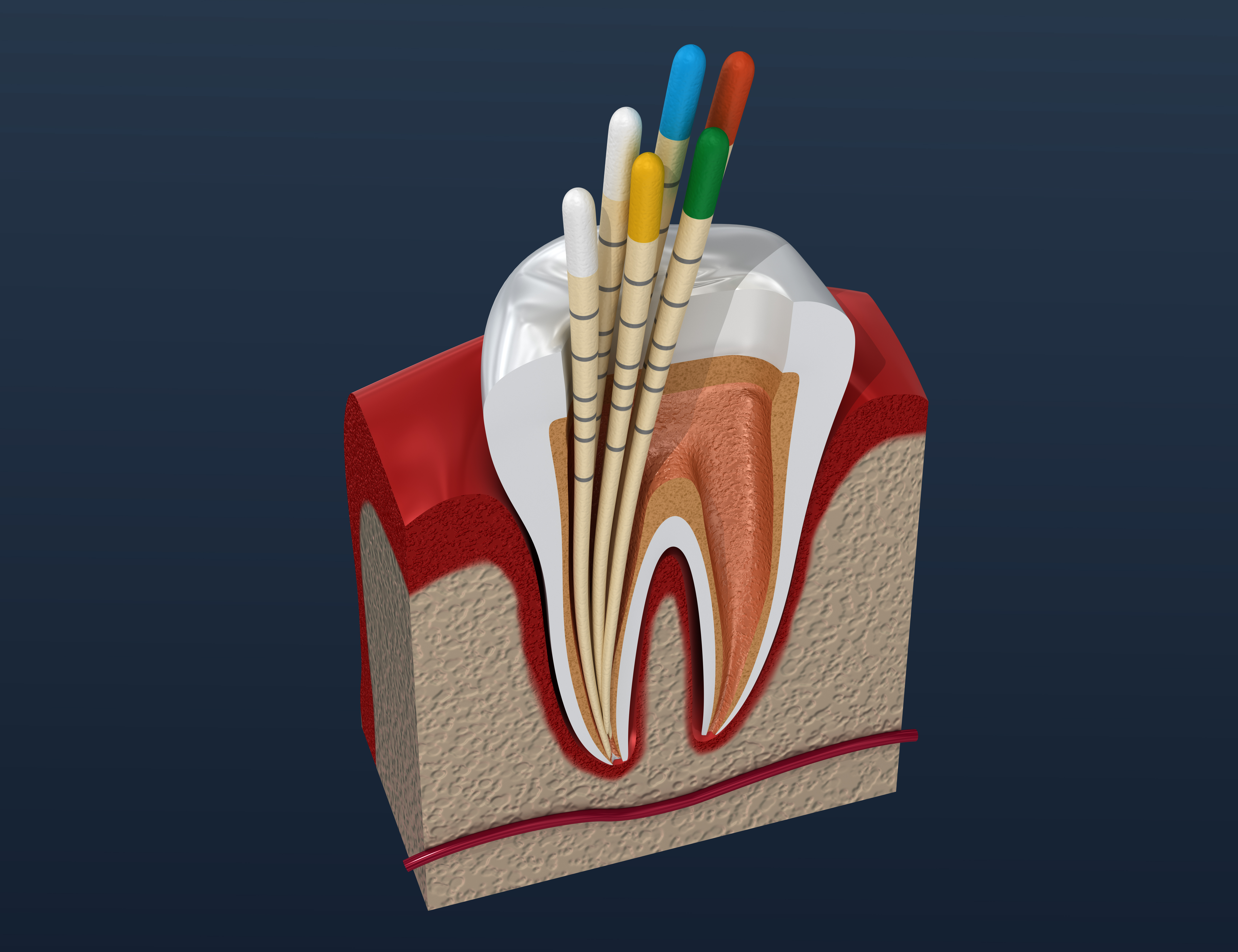 Gutta percha endodontics instrument, dental anatomy. 3D illustration Gutta percha endodontics instrument, dental anatomy. 3D illustration
