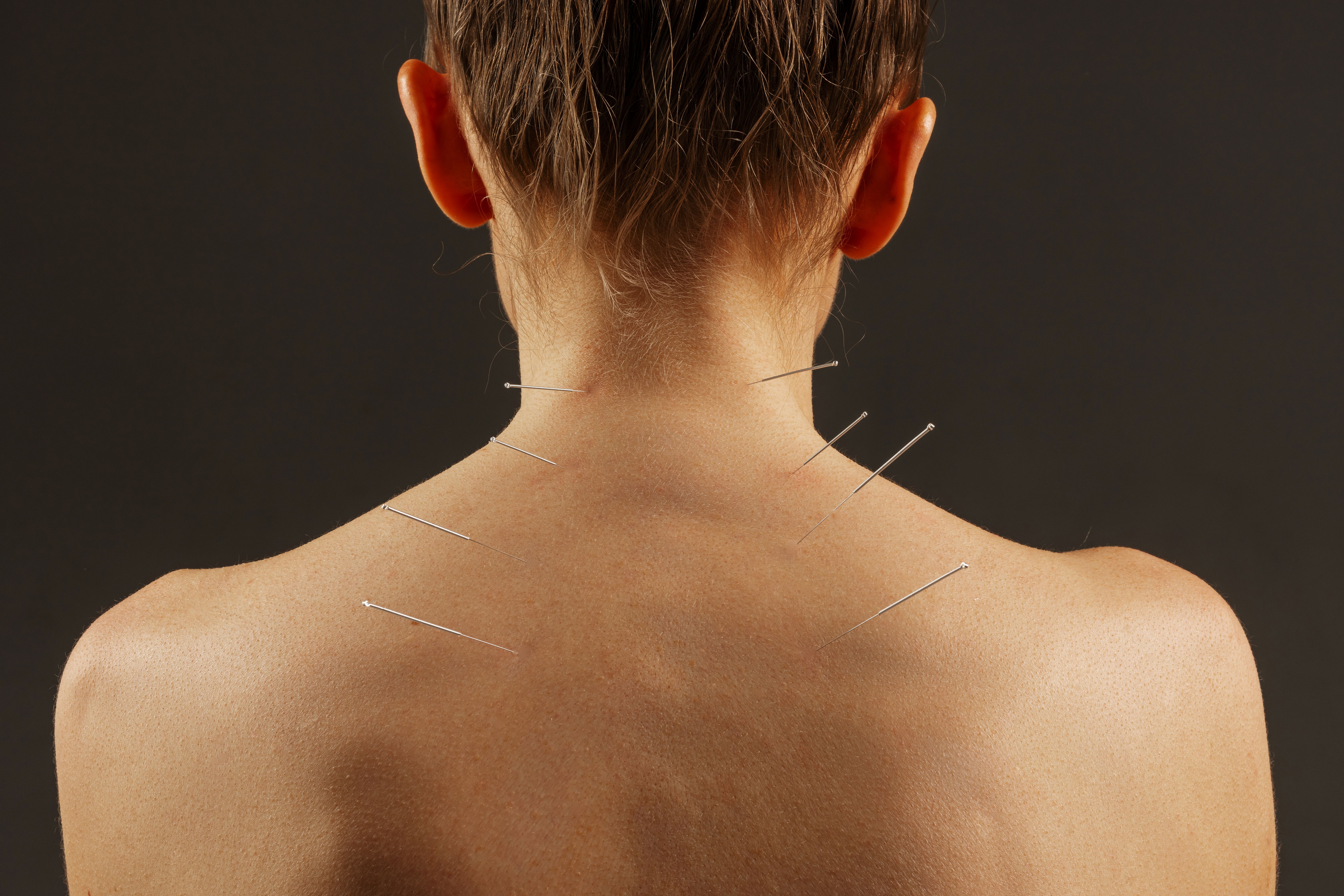 acupuncture treatment