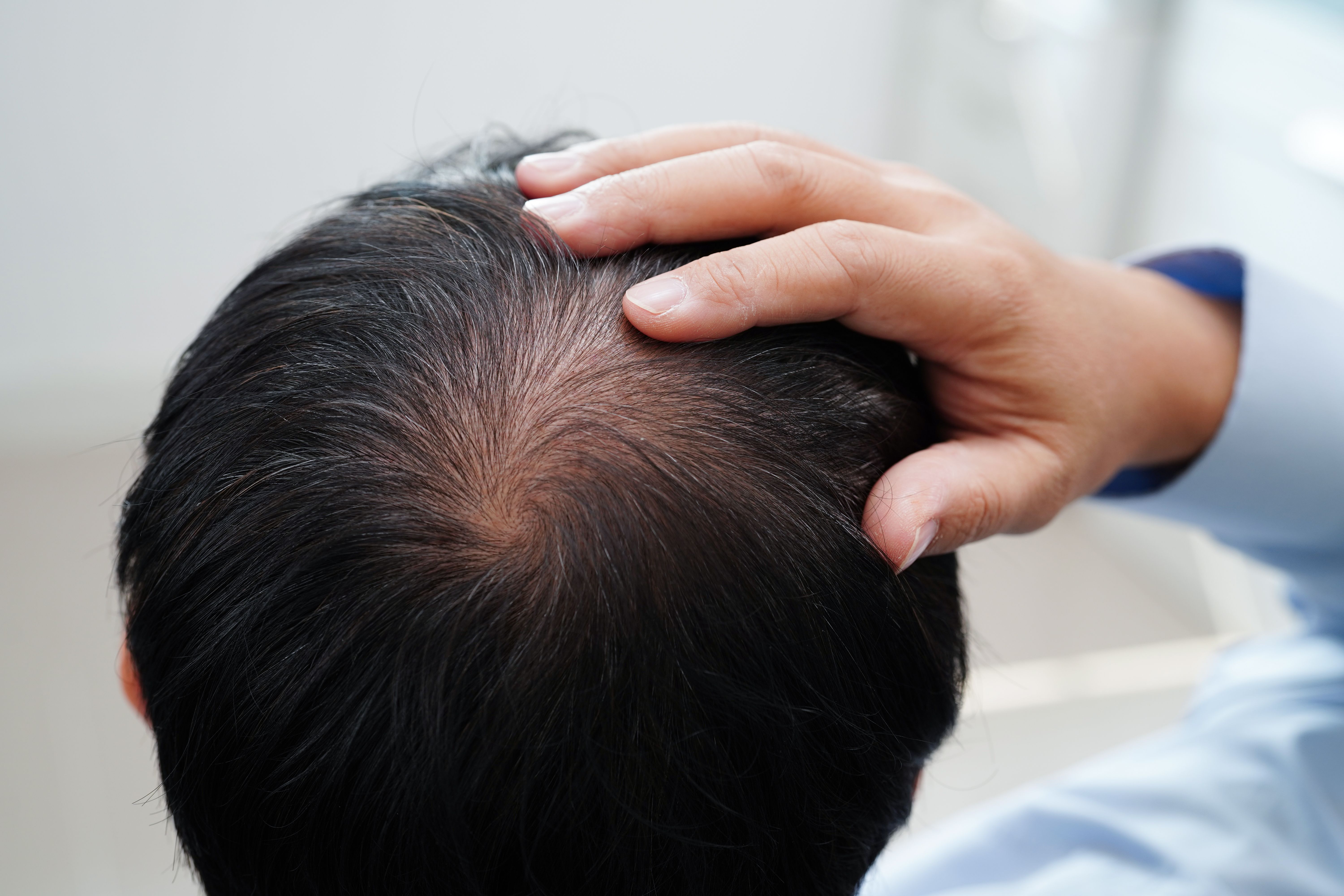 hair loss treatment prp leicester. hair study, prp study hair loss